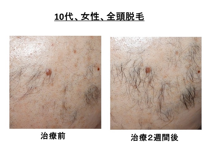 円形脱毛症　病院